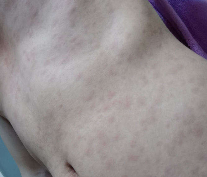 不要錯把愛滋病當皮膚病!身體若有3種變化,不排除是愛滋病早期