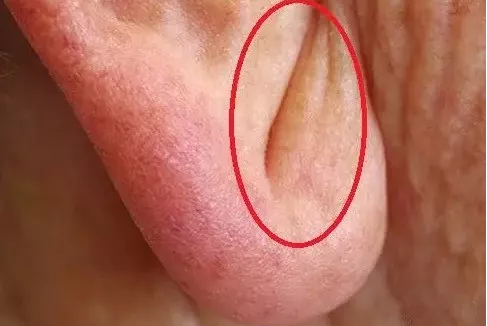 面相和健康有什么关系?分享2种方法,自测心脏和血管健康 面相和健康有什么关系?分享2种方法,自测心脏和血管健康